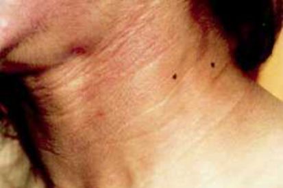 Diabetes-Related-Skin-Conditions3