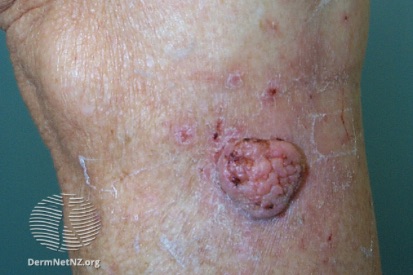 Skin-Cancer-5