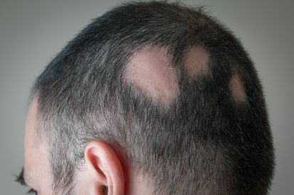 Alopecia-and-Hair-Loss-3
