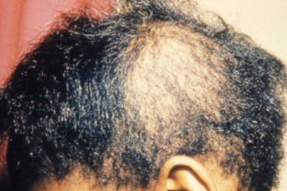 Alopecia-and-Hair-Loss-1