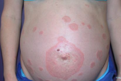 Pregnancy-Related-Skin-Conditions1