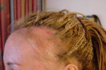 Alopecia-and-Hair-Loss-2